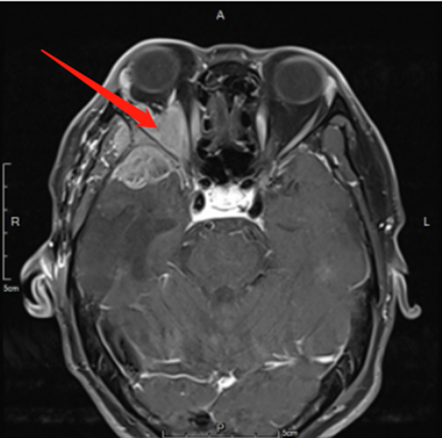 【关注】男子差点摘除眼球，竟因……