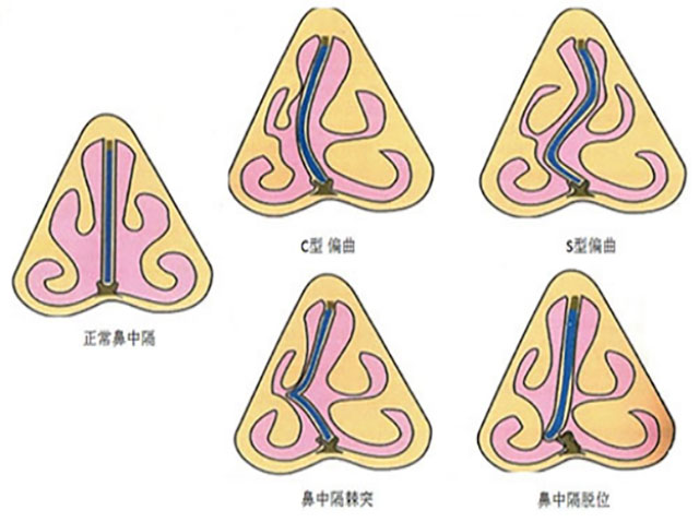 【围观】鼻塞,可能是鼻子里面弯了?(图2) 2.jpg