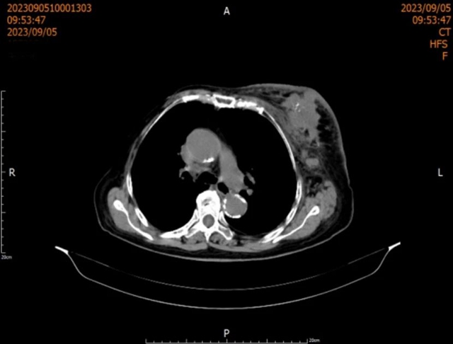 【围观】乳腺癌20年,83岁奶奶竟然……(图3) 微信图片_20231011091540.jpg