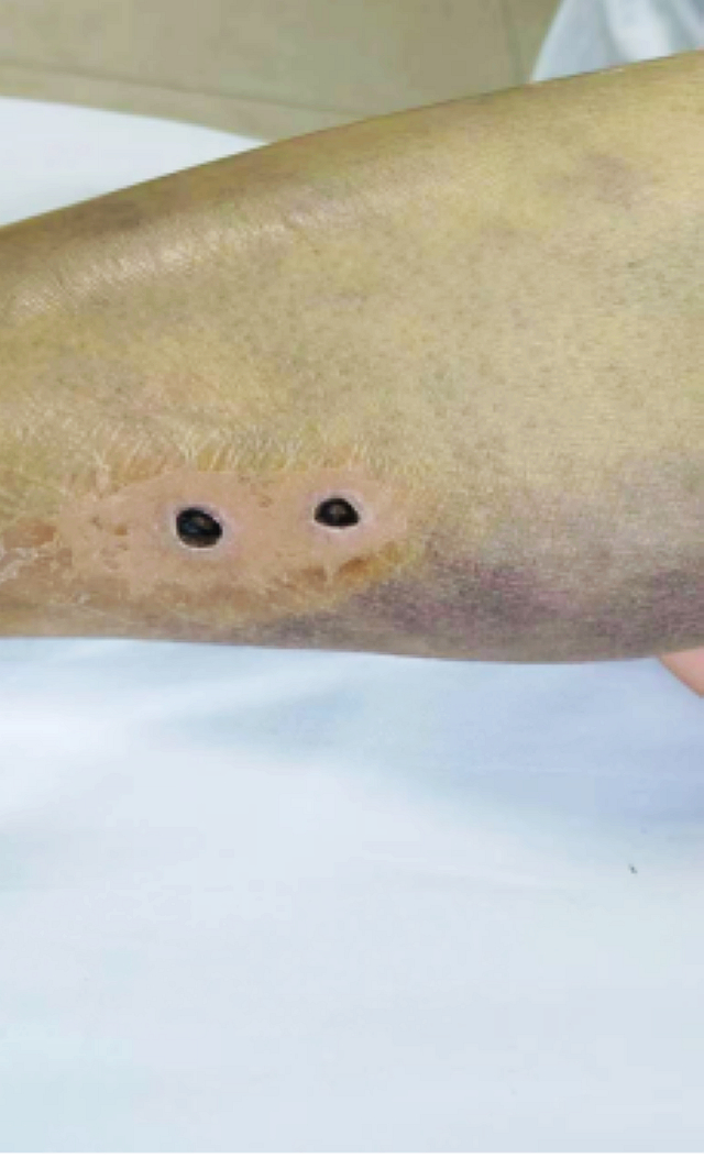 【围观】泸州嬢嬢被一群毒蜂ju了,病危……(图7) nEO_IMG_7.jpg