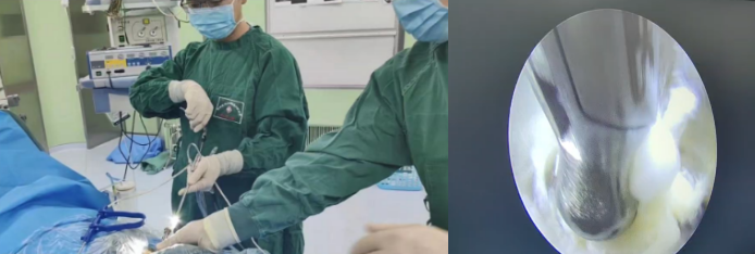 【关注】切口不到1厘米,腰椎间盘突出患者福音!(图4) 微信图片_20231017093051.png