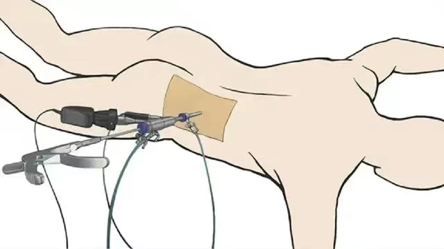 【关注】切口不到1厘米,腰椎间盘突出患者福音!(图6) 微信图片_20231017093059.png