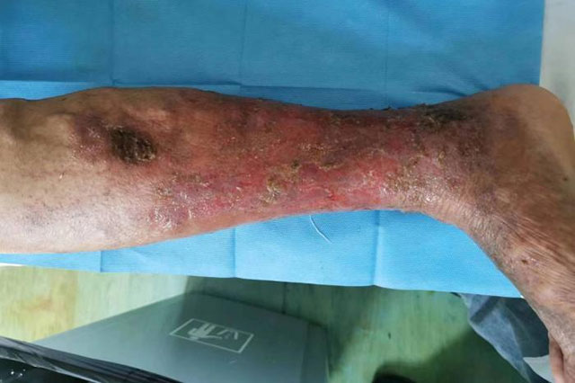 【围观】年纪轻轻,泸州男子双腿险些毁掉……(图4) 4.jpg