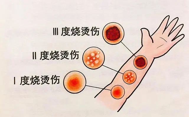 【围观】“脆皮大学生”,炸香肠炸出二度烫伤!(图7) 微信图片_20231023095722.jpg