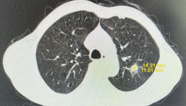 【围观】仅三个月,肿瘤就消失了,癌症有那么可怕吗?(图5) 微信图片_20231026092955.jpg
