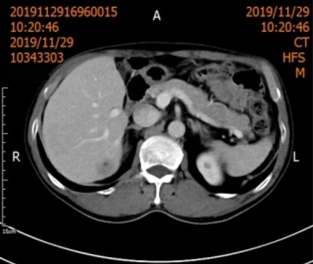 【围观】超低温-160 ℃,冻死肿瘤,癌症不用开刀了(图2) 微信图片_20231027104457.jpg
