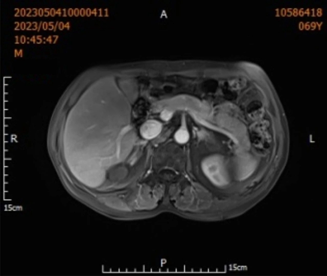 【围观】超低温-160 ℃,冻死肿瘤,癌症不用开刀了(图7) 微信图片_20231027104525.jpg