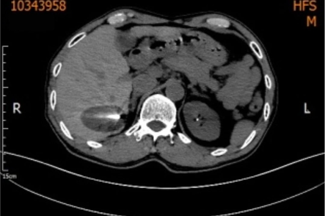 【围观】超低温-160 ℃,冻死肿瘤,癌症不用开刀了(图4) 微信图片_20231027104507.jpg