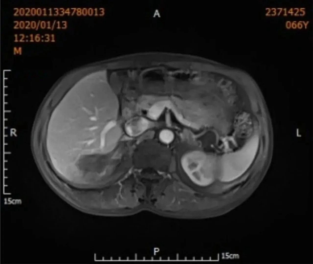 【围观】超低温-160 ℃,冻死肿瘤,癌症不用开刀了(图5) 微信图片_20231027104515.jpg