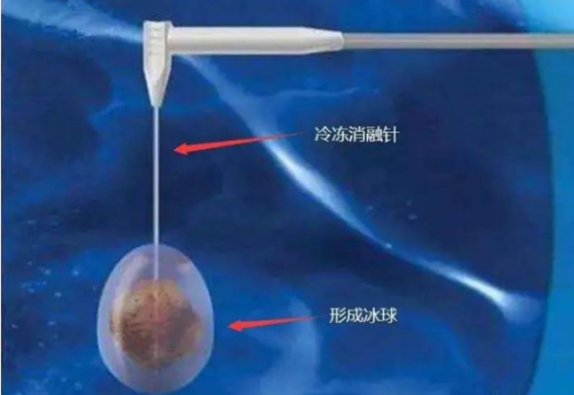 【围观】超低温-160 ℃,冻死肿瘤,癌症不用开刀了(图11) 微信图片_20231027104550.png