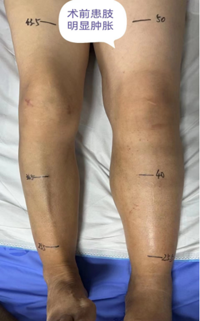 【技术】合江县中医医院普外科成功为髂静脉压迫致下肢深静脉血栓患者实施介入治疗