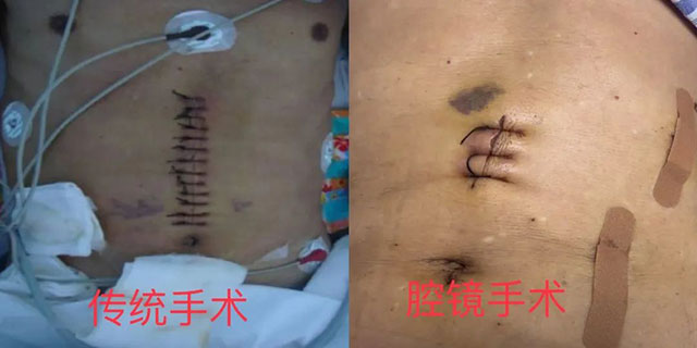 泸州福欣医院成功开展“腹腔镜+胃肠镜联合胃癌根治术”!(图4) 4.jpg