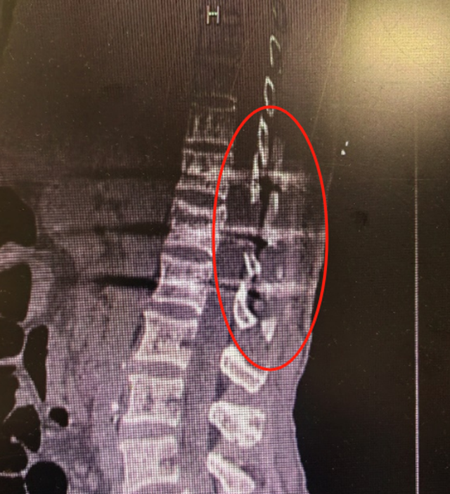 【围观】大妈从5米高坡摔下，胸椎爆裂骨折……