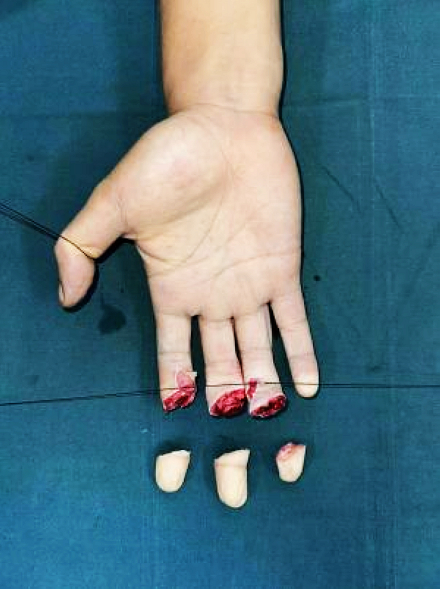 【硬核】泸州小伙被桌子压断3根手指，6个小时，接好！