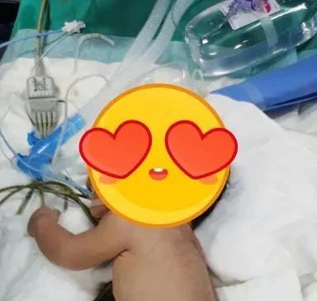 【惊险】发病率1/2000～1/3000！出生近8小时，“膈疝宝宝”酒城求生记