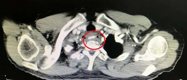 【围观】医生一夜消灭十多个“白骨精”......