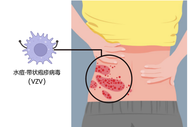 【关注】可怕的“蛇缠腰”,缠满一圈就会死人吗?(图5) 微信图片_20240209092829.png