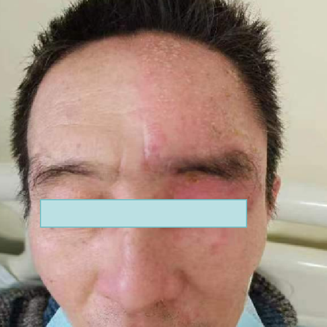 【关注】可怕的“蛇缠腰”，缠满一圈就会死人吗？