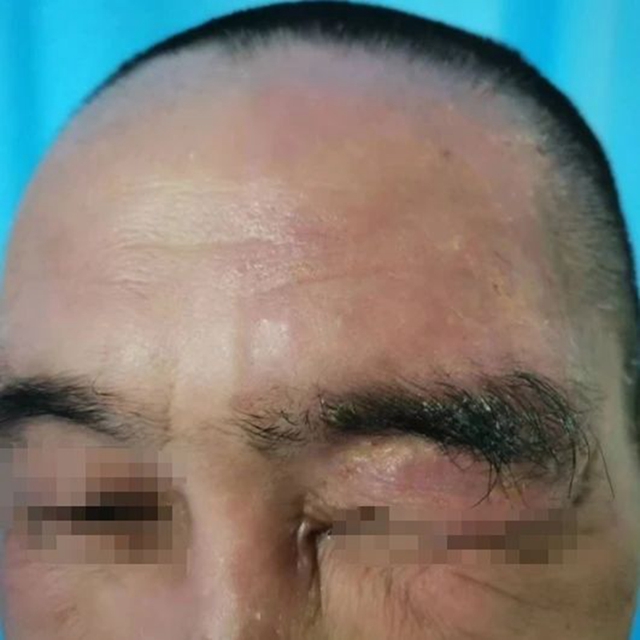 【关注】可怕的“蛇缠腰”,缠满一圈就会死人吗?(图2) 微信图片_20240209092815.jpg