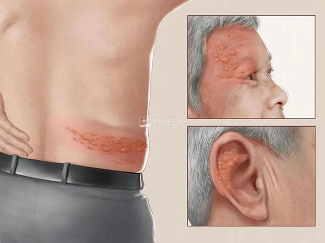 【关注】可怕的“蛇缠腰”,缠满一圈就会死人吗?(图4) 微信图片_20240209092824.jpg