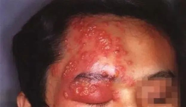 【关注】可怕的“蛇缠腰”,缠满一圈就会死人吗?(图9) 微信图片_20240209092847.jpg