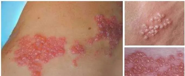 【关注】可怕的“蛇缠腰”,缠满一圈就会死人吗?(图11) 微信图片_20240209092859.jpg