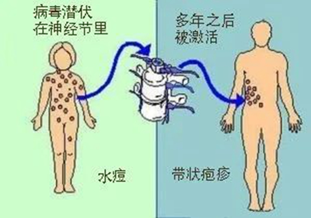 【关注】可怕的“蛇缠腰”,缠满一圈就会死人吗?(图14) 微信图片_20240209092915.jpg