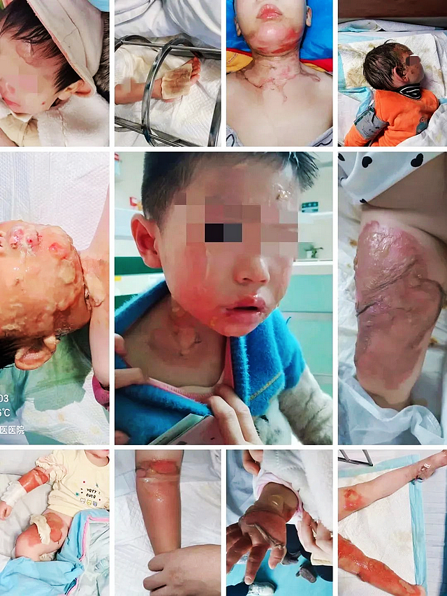 【围观】泸州一女孩摔倒在煮沸的火锅汤汤里