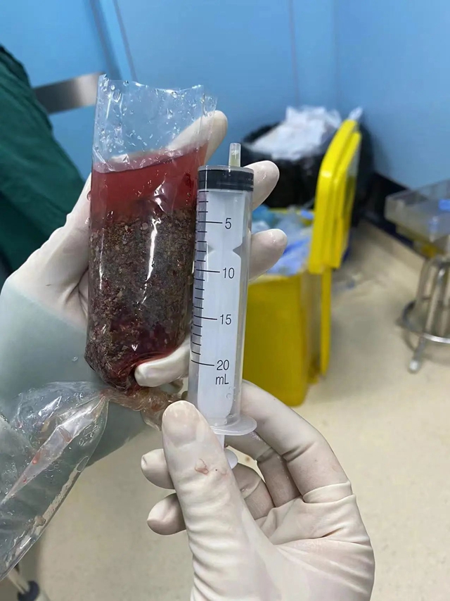 【围观】 泸州男子肾脏装满“石子”！