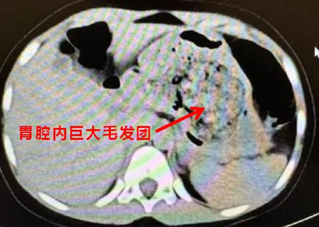 【围观】5岁女孩确诊“长发公主综合征”？多地已有病例，医生提醒