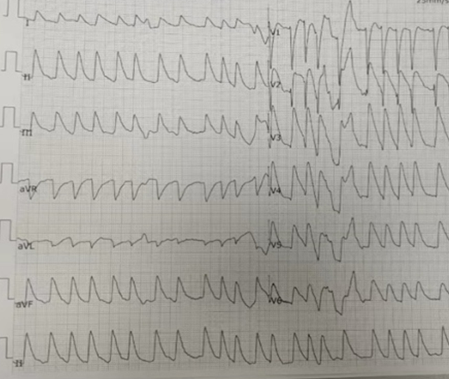 彝乡老大爷急性心肌梗死！他硬是给“拽”了回来！