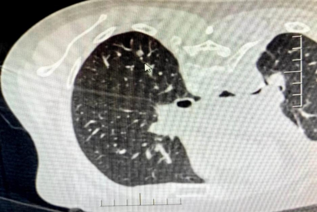 以“针”代“刀”，看他们如何一针“烧死”肺癌