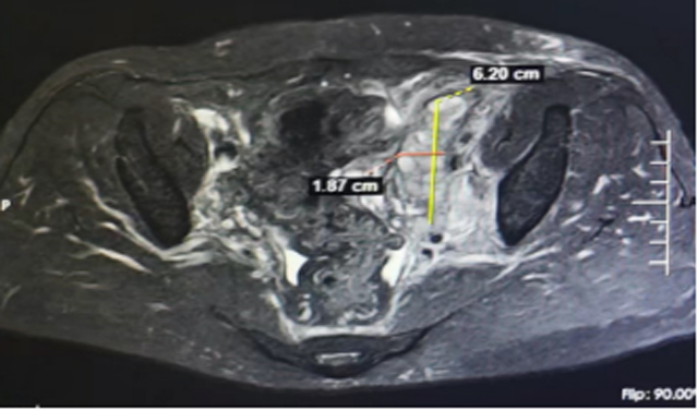 7个月肿瘤缩小70%！“华山论剑”为难治性疾病患者谋福祉