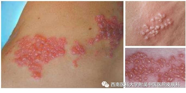 【扩散】这个病，死不了但折磨人！这4类人要当心