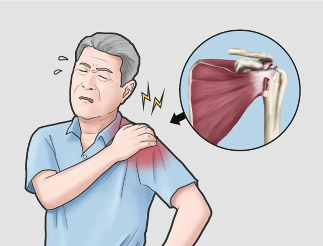 专病专治 精准诊疗┃合江县中医医院肩袖损伤及膝痹病专病门诊