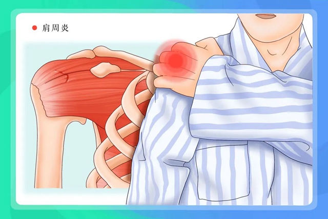 专病专治 精准诊疗┃合江县中医医院肩袖损伤及膝痹病专病门诊(图3) 3.jpg