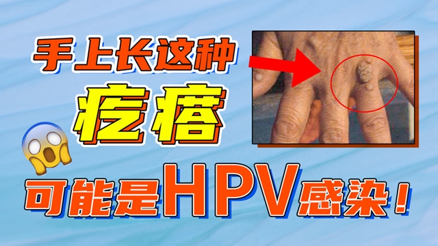 【警惕】一身长疣，HPV感染惹得祸？