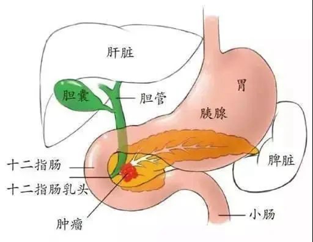 【警惕】肚子痛了半个月，一查竟是癌......