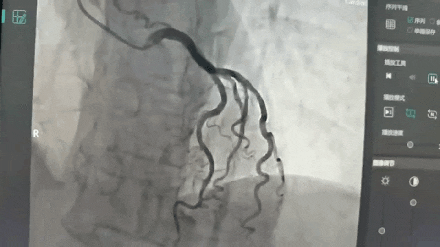 整体诊疗水平再上新台阶┃泸州福欣医院成功开展2例心脏介入手术