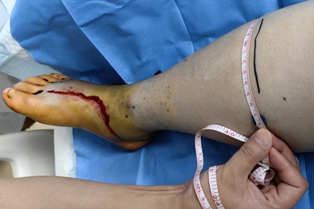 【当心】泸州孃孃被毒蛇咬伤,竟尿血……(图4) 4.jpg