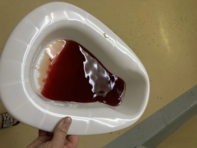 【当心】泸州孃孃被毒蛇咬伤,竟尿血……(图3) 3.jpg