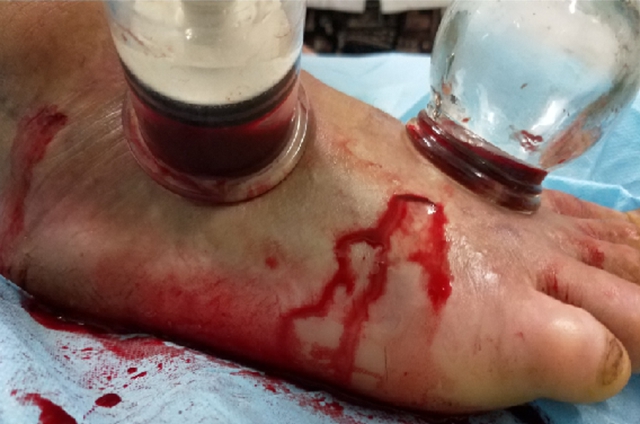 【当心】泸州孃孃被毒蛇咬伤,竟尿血……(图7) 7.jpg