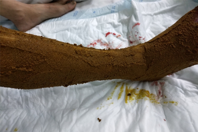 【当心】泸州孃孃被毒蛇咬伤,竟尿血……(图8) 8.jpg