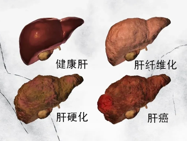 【技术】“介入+靶免”强强联合，为肝癌患者带来新“生机”！