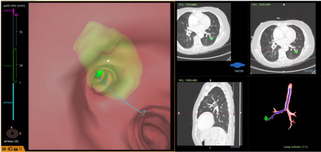 四川首例“红袖刀”手术成功实施,为高危肺结节患者带来新希望(图3) 3.png