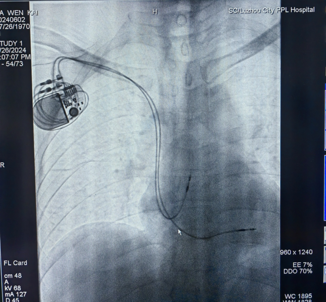紧急!泸州大爷心脏停跳,“生死时速”助其“心”生(图4) 4.png