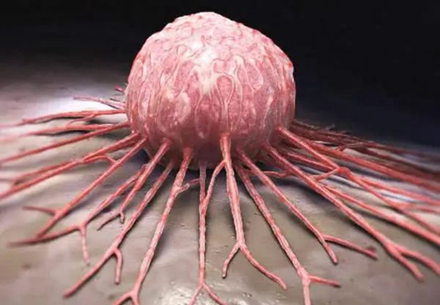 【反转】男子高烧、腹泻，竟查出个肿瘤……