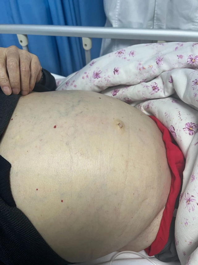 【提醒】肚子大未必就是胖，当心肝腹水......