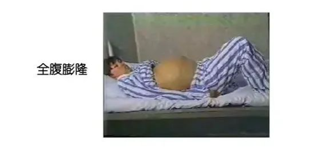 【提醒】肚子大未必就是胖,当心肝腹水......(图6) 微信图片_20240910095143.png