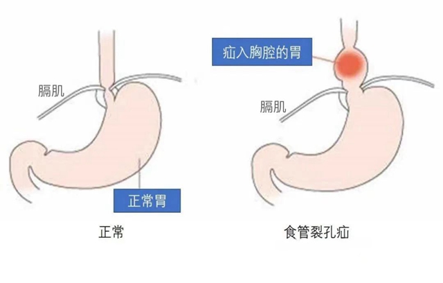 【围观】一吃就吐，男子胃部“窜”进了个大洞......